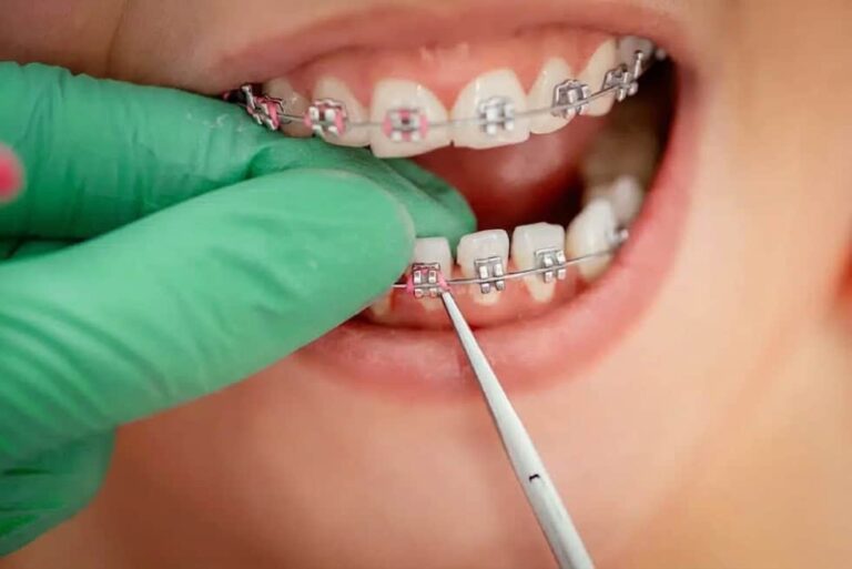 Apparecchio ortodontico e sbiancamento dentale